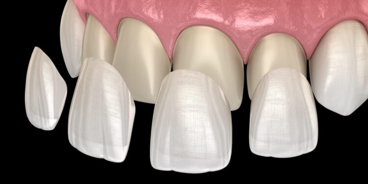 Porcelain Veneers in Dental